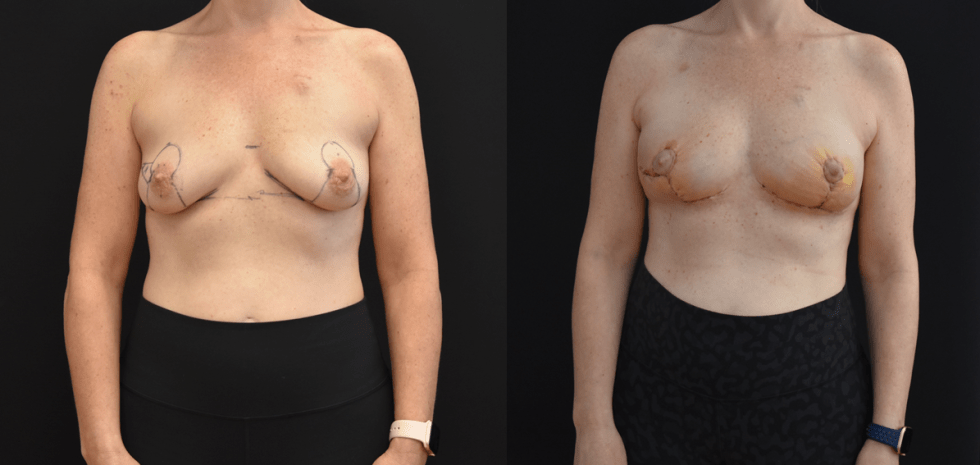 The image shows the early stages of post-op healing from Oncoplastic Lumpectomy Defects