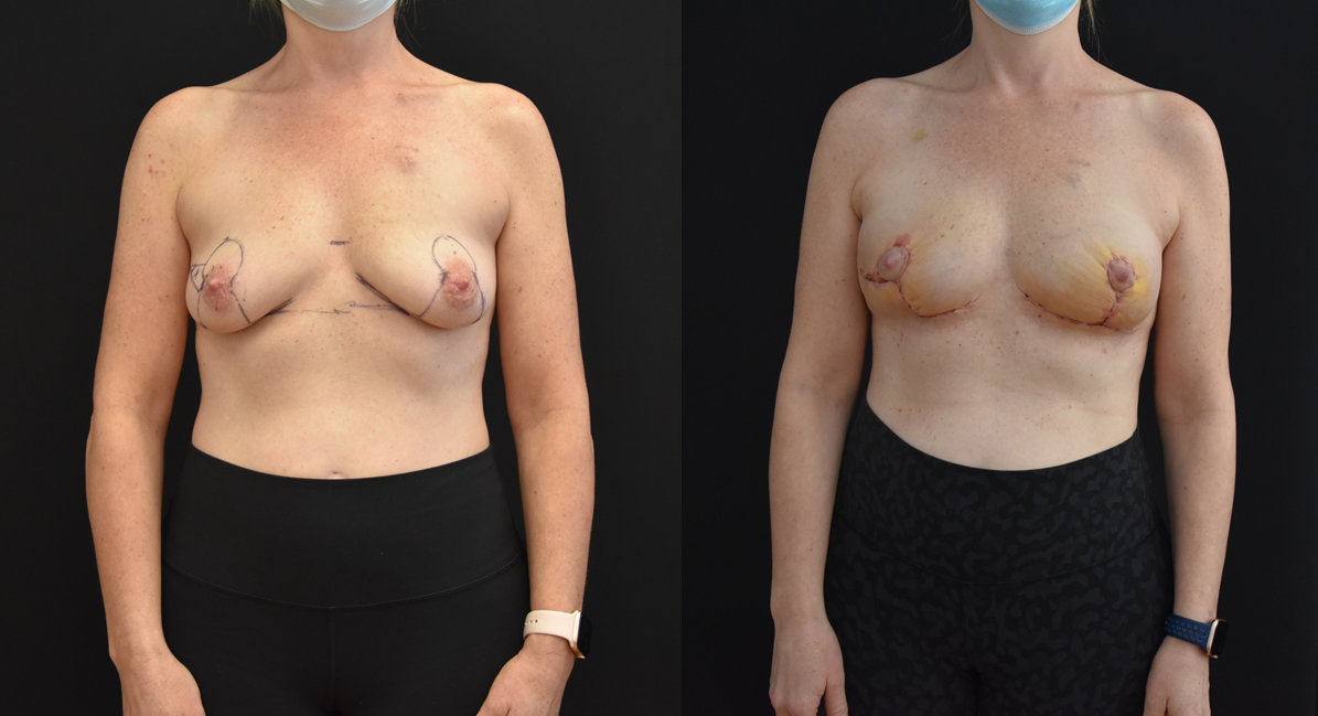 The image shows the early stages of post-op healing from Oncoplastic Lumpectomy Defects