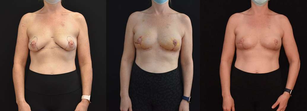 Image displays the healing process following oncoplastic reconstruction of lumpectomy defects.