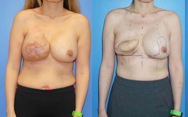 Staged Reconstruction of an Exposed Mastectomy Implant Reconstruction