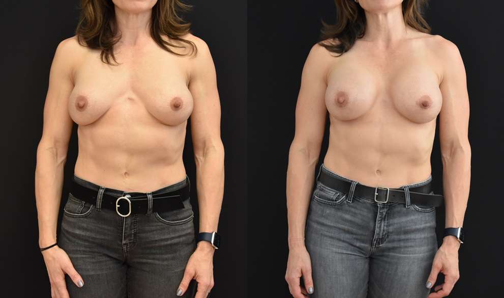 The photo describes how breast augmentation shape can be improved with secondary breast augmentation.