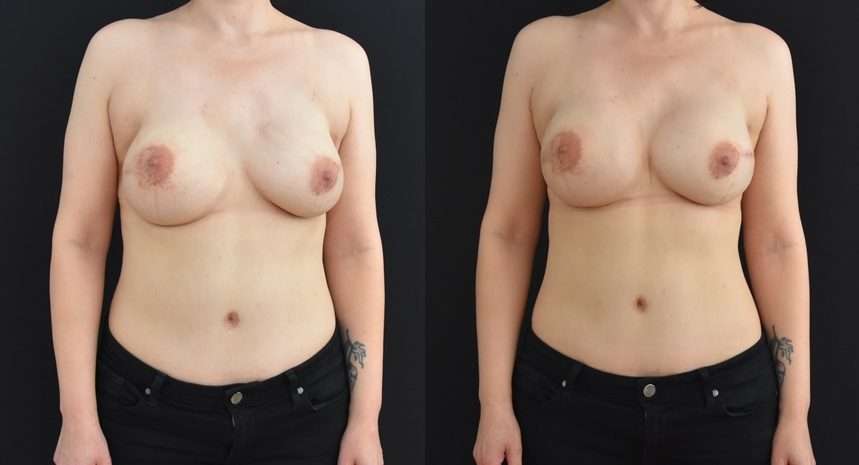 Image displays Secondary Mastectomy Reconstruction when tissues are thin