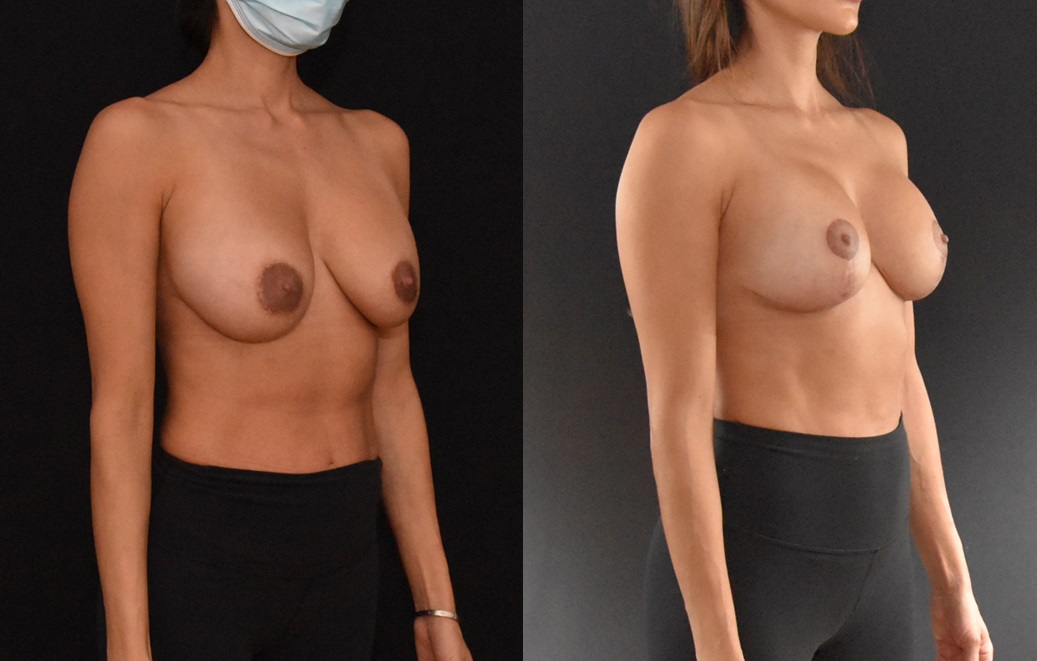 Brian Dickinson, MD Secondary Mastopexy Augmentation