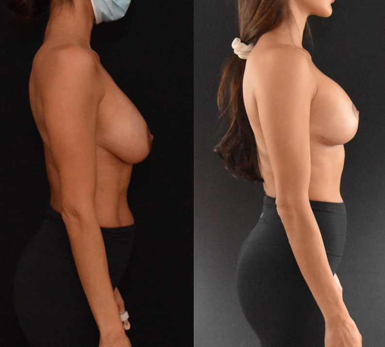 Brian Dickinson, MD Secondary Mastopexy Augmentation