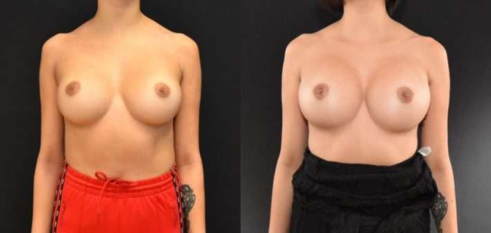 Trans-Axillary Breast Augmentation