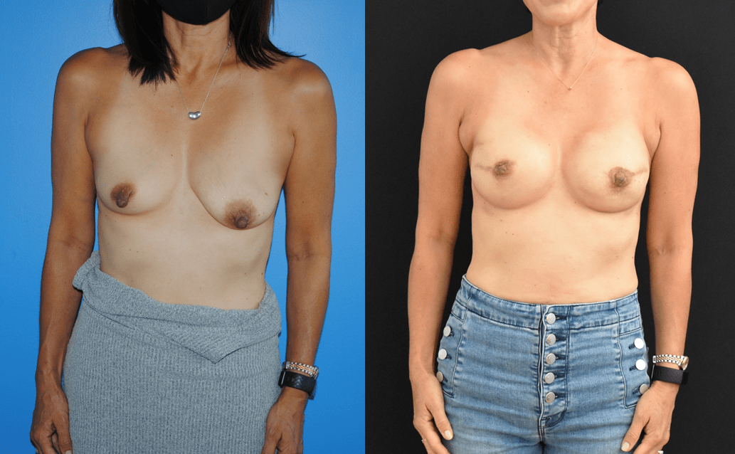 Post-operative results for bilateral mastectomy and tissue-expander implant reconstruction