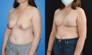 Bilateral Mastectomy and Tissue Expander