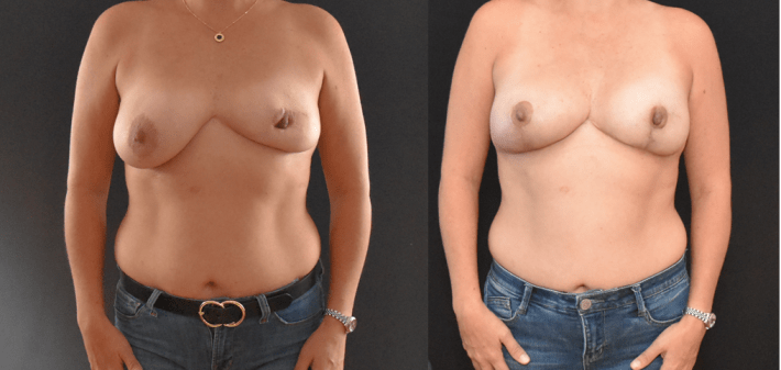 Breast Augmentation and Mastopexy in Breast with Previous Infection
