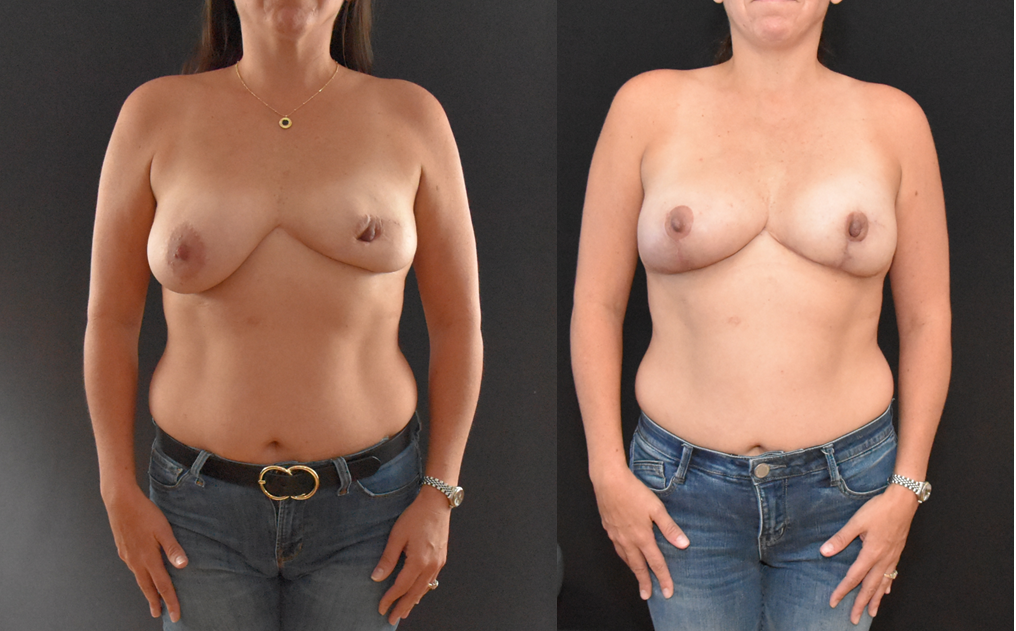 Breast Augmentation and Mastopexy in Breast with Previous Infection