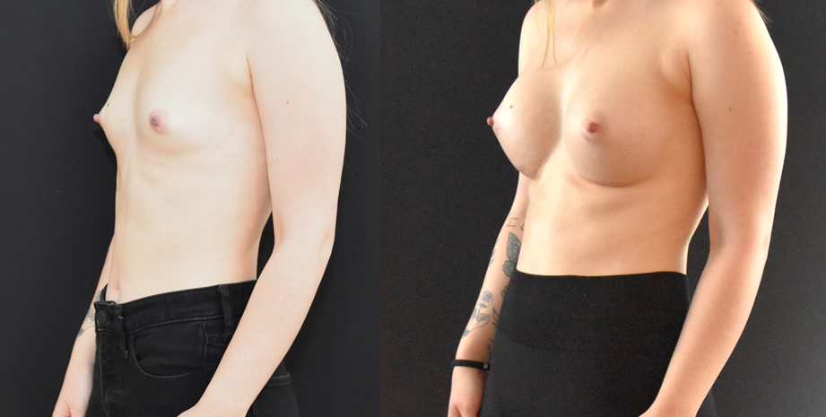 Breast Augmentation Before and After Oblique Natural Breast Augmentation