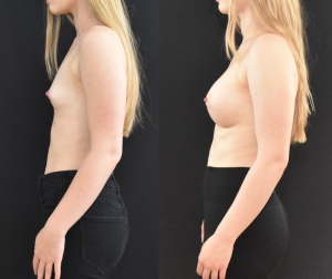 Breast Augmentation Side Profile Before and After