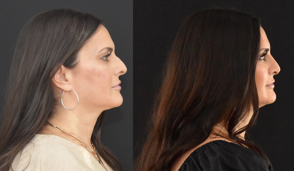 Rhinoplasty Before and After Profile View