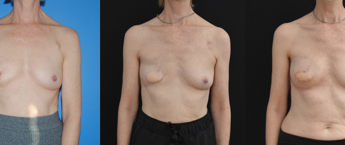 Latisimus Dorsi Flap Breast Reconstruction