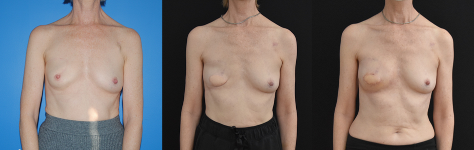 Latisimus Dorsi Flap Breast Reconstruction