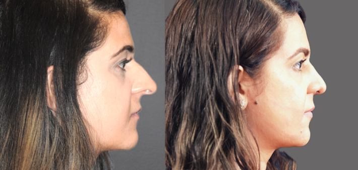 Image shows how to deproject the nasal tip