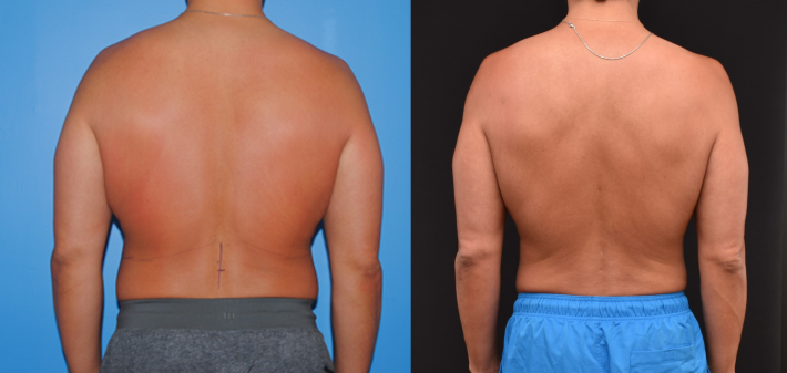 Back & Flank Liposuction 2-Year Follow-Up