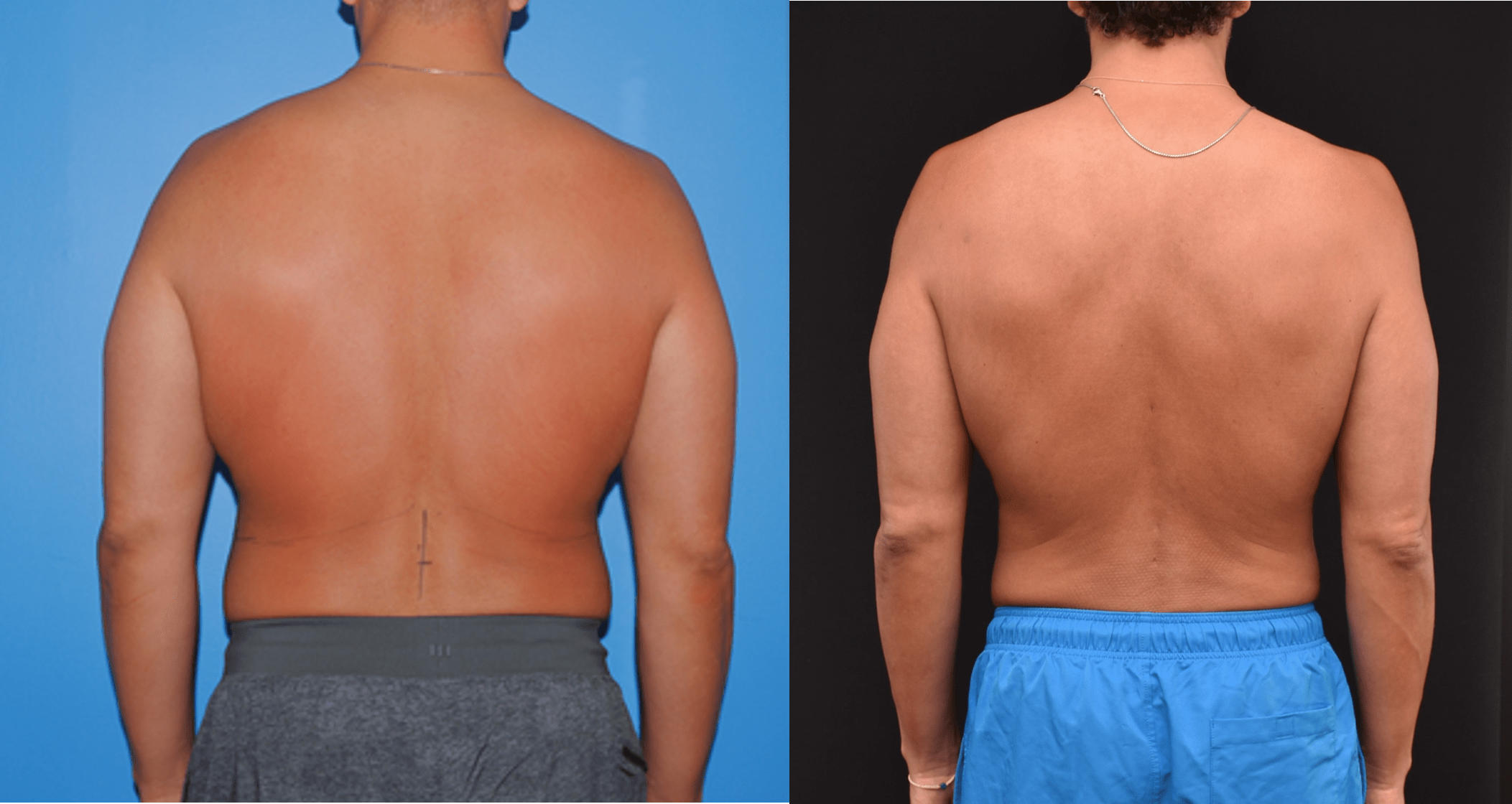 Back & Flank Liposuction 2-Year Follow-Up