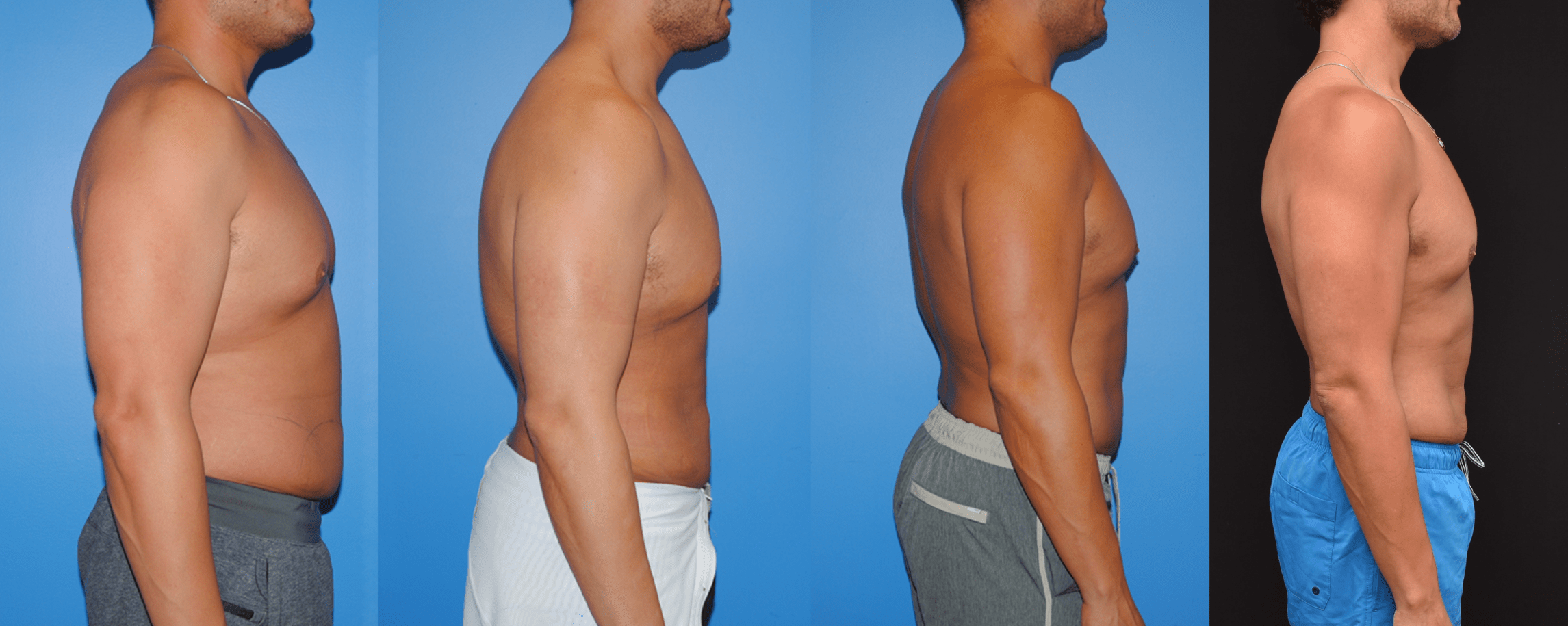 Liposuction of the Back, Abdomen, and Flanks