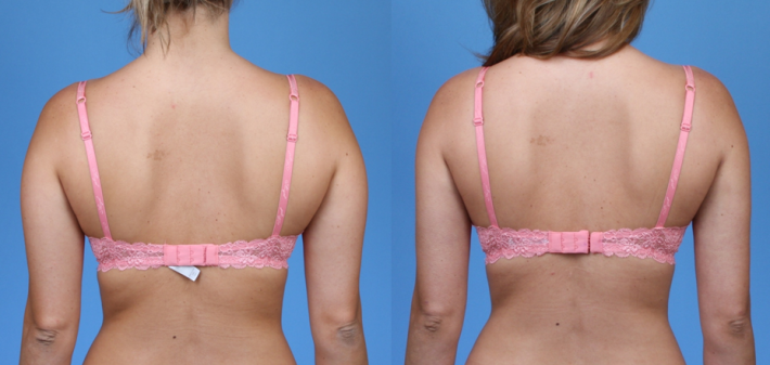 Liposuction of Arms and Bra Fat