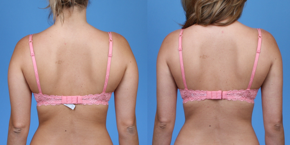 Liposuction of Arms and Bra Fat