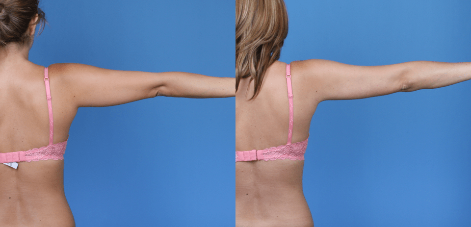 Arm Liposuction to Improve Body Contour