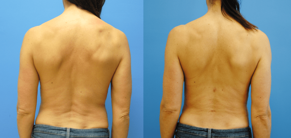 Lower Back Liposuction in Female Athletes