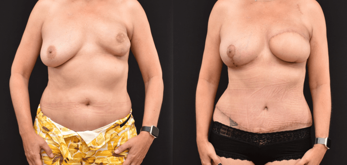 Before and After photograph of a unilateral DIEP flap post mastectomy and radiation.