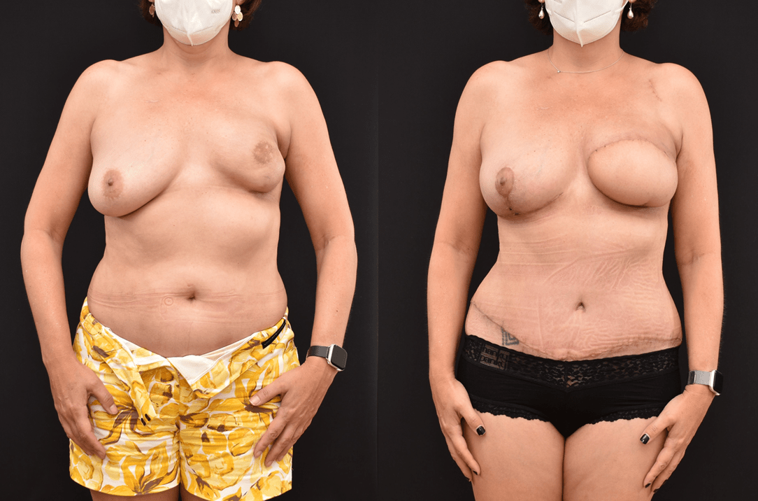 Before and After photograph of a unilateral DIEP flap post mastectomy and radiation.